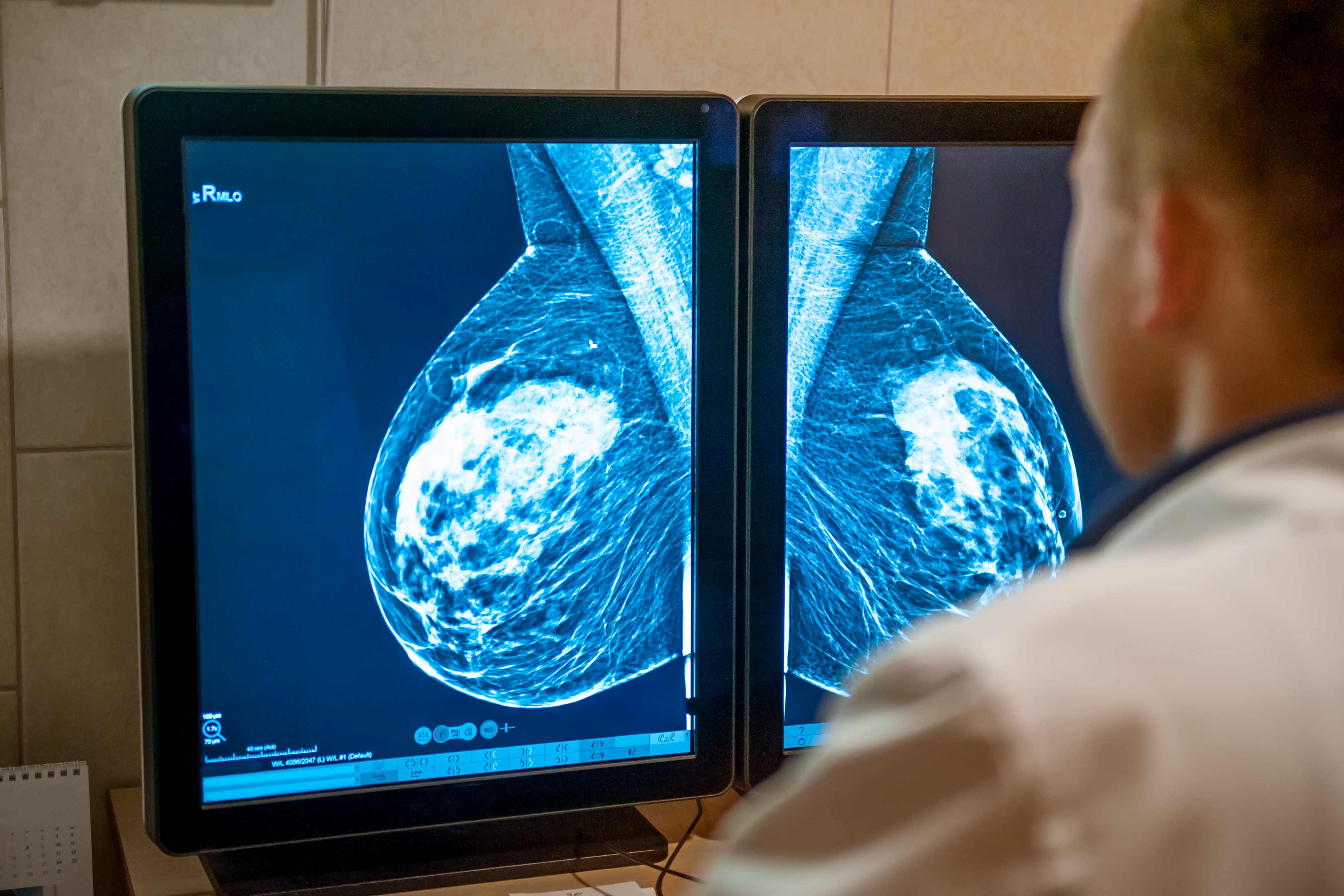 Triple-negative breast cancer is aggressive, harder to treat, and more likely to spread to other organs. 